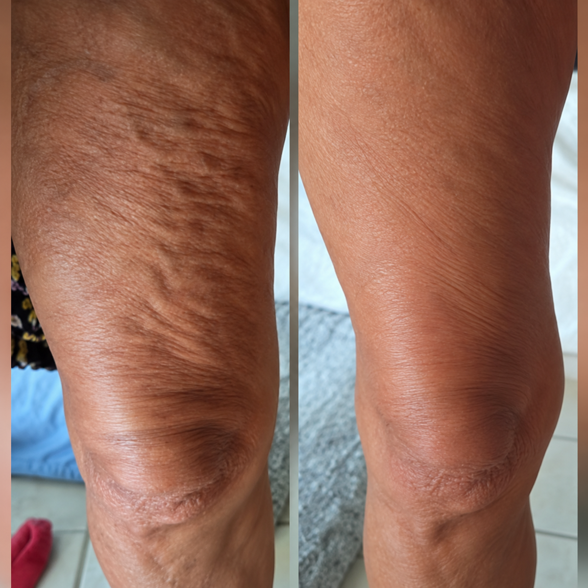 Firméa AntiCelulitis - Reafirma y suaviza tu piel